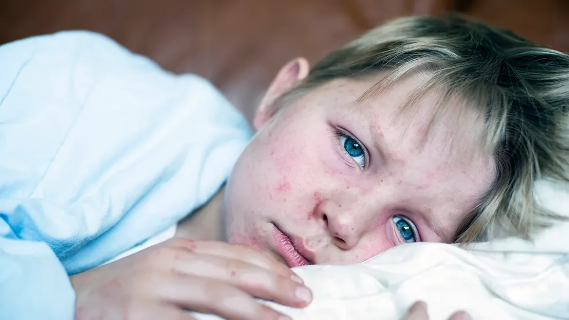 Measles: The World's Most Contagious Virus – How to Stay Safe