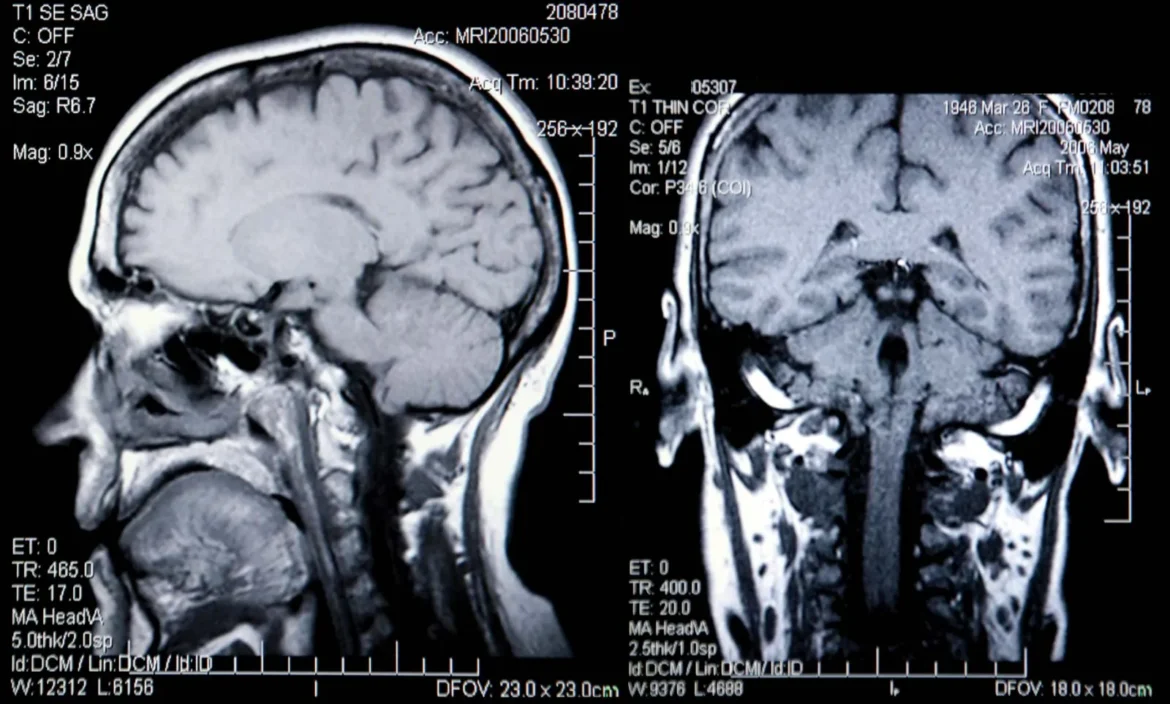 “CHEMO BRAIN” IS REAL NEW STUDY REVEALS HOW CHEMOTHERAPY DISRUPTS BRAIN CONNECTIVITY IN BREAST CANCER PATIENTS