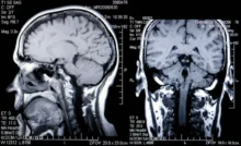“CHEMO BRAIN” IS REAL NEW STUDY REVEALS HOW CHEMOTHERAPY DISRUPTS BRAIN CONNECTIVITY IN BREAST CANCER PATIENTS